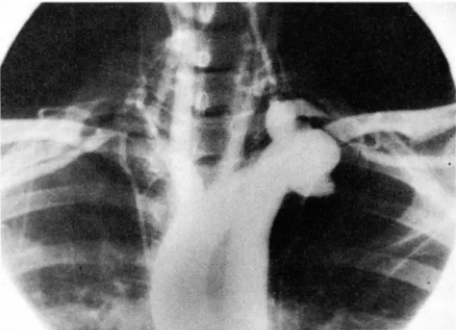 Fig.  3.  Aortogram  (Left  Cervical Aortic  Arch) 