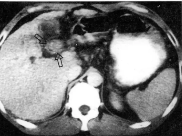 Fig.  1.  CT scan shows well marginated soft tissue mass  within the common hepatic duct (arrows)