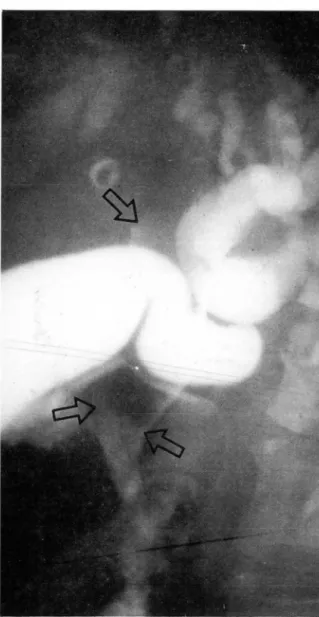 Fig.  7.  Two  months  after  operation.  T-tube  cholangiogram reveals the tumor recurrence in cornmon  hepatic duct (arrows)