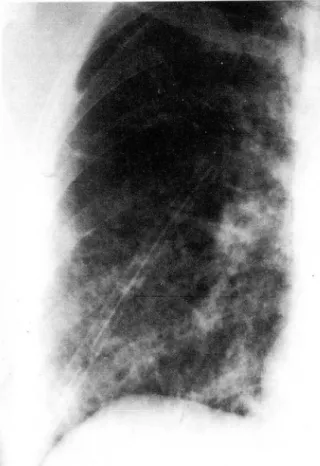 Fig.  1.  Chest  radiograph  shows  right  pneumothorax  with wide spread reticulonodular increased densities on  both lung fields