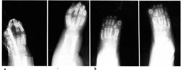 Fig.  2.  Plain films of both hands and feet 