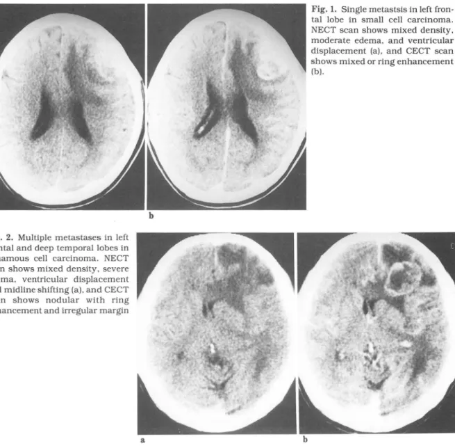 Fig.  2.  Multiple  metastases in  left  frontal and deep temporallobes in  squamous  cell  carcinoma