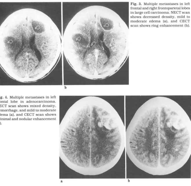 Fig.  4.  Multiple  metastases in  left  frontal  lobe  in  adenocarcinoma  NECT  scan  shows  mixed  density