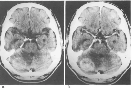 Fig. 5.  Multiple metastases in right  cer ebellum and left frontal lobe  in  small  cell  carcinoma