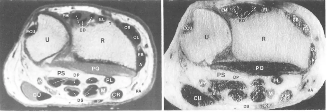 Fig.  1.  Transverse  MR  image  (a)  and  cadaveric section (b)  through  level  of distal  radioulnar j oint 