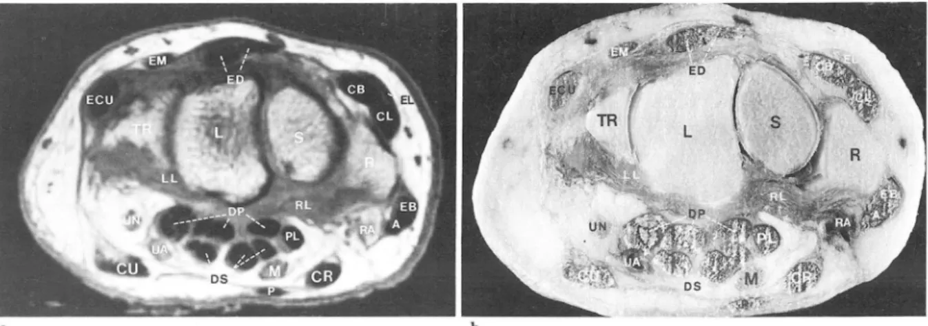 Fig.  2.  Transverse MR  image (a)  and cadaveric  section  (b)  through  level  of proximal  carpal row 