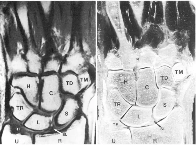 Fig_  4_  Coronal  MR  image (a ) a nd cadaveric  sectio n  (b)  throu gh level  of carpa l  bones