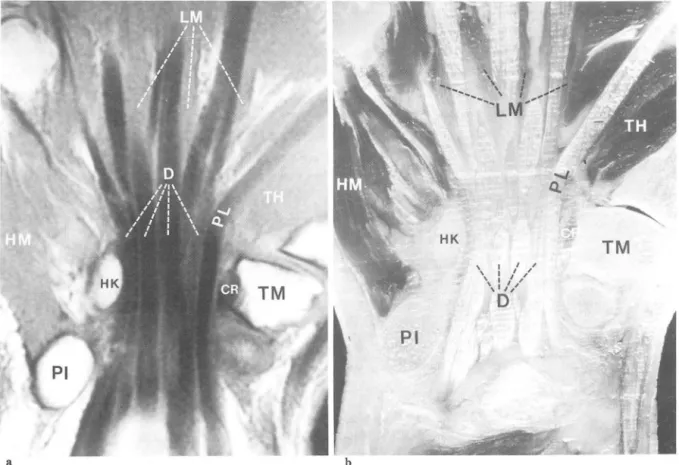Fig. 5.  Coronal MR  image  (a)  and cadaveric section (b)  through level  of carpal tunne l