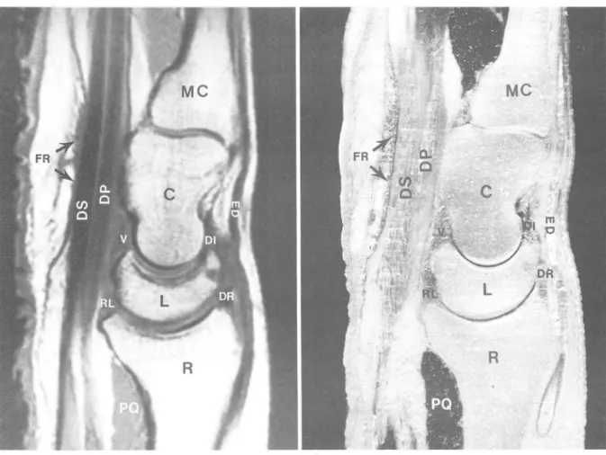 Fig.  7.  Sagittal  MR  image  (a)  a nd  cadaveric  section (b)  through level  of  3rd metacarpal  bone 
