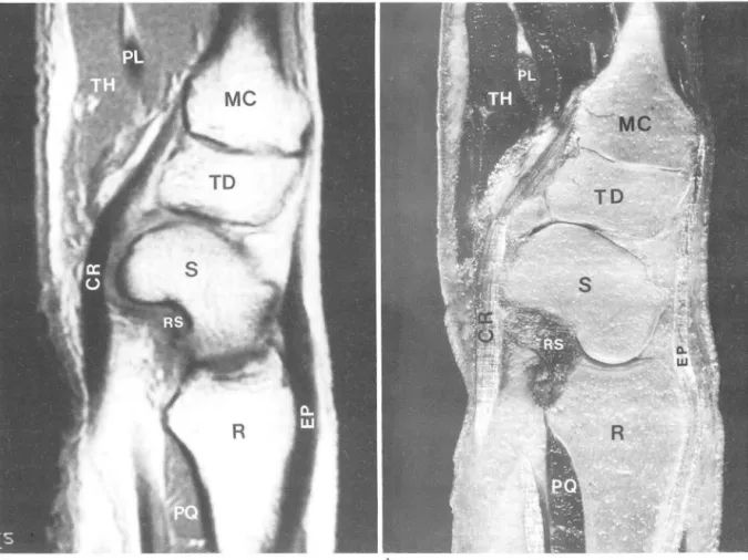 Fig.  8.  Sagittal MR image (a)  and cadaveric  section  (b)  through levei  of scaphoid 