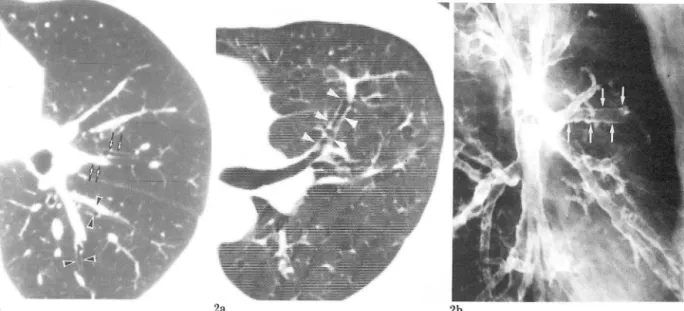 Fig_  L  Hi gh  resolution CT  of normall eft  lun g  sho \V s  no identifiable  bronchi in  th c  periph e ry of the le ft  upper lobe  and Icft  lower  lobe ‘  Th e  same orde r  bronchi  have  similar wall  thic ke ness a nd  outer diameter [arrow  h ea