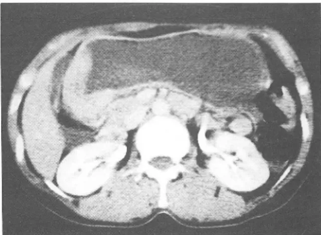 Fig.  2.  Borrman  ty pe  II  a d e nocarcinoma .  Localized  thicke ning  (about  l c m)  of  lesser  c urva ture  of  upper  body with  small ulcer a tion