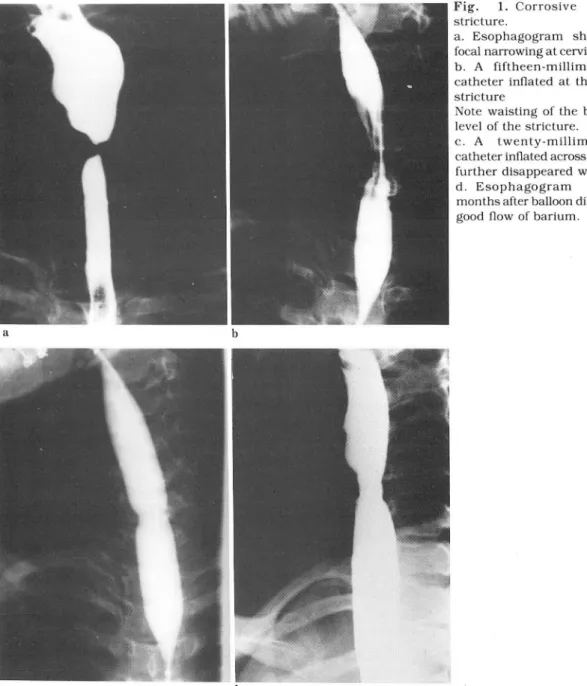 Fig.  1.  Corrosive  esophageal  stricture. 