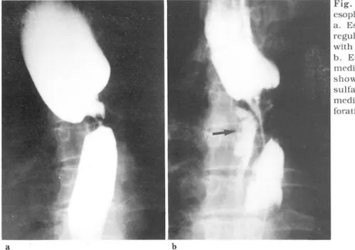 Fig.  4.  Malignanl  slriclure  by  esophageal  carcinoma 