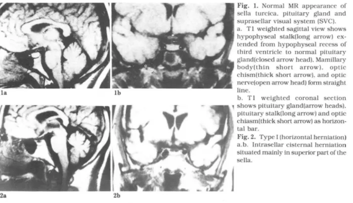 Fig.  1.  Normal  MR  appearance  of  se lla  turcica.  pituitary  gland  an d  suprasellar v isua l  system (SVC)  a