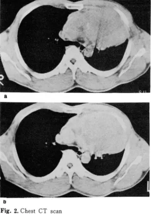 Fig.  2. Chest  CT  scan 