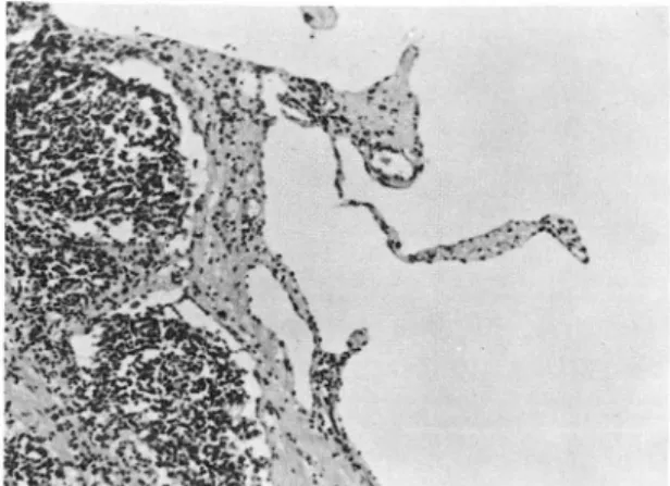 Fig.  1.  (a)  CT  scan  at  the  regi on  of  body  of  the  pan - -creas  revea ls  huge  oval  shaped cys tic  lesion  in  gas  tro-hepatic  space