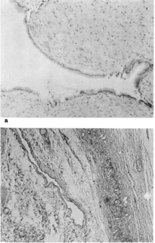 Fig.  6a.  The  cystic  space  is  lined  by  single  layer  of  tall  columnar  epithelial  cells.(HE ,  X 40) 