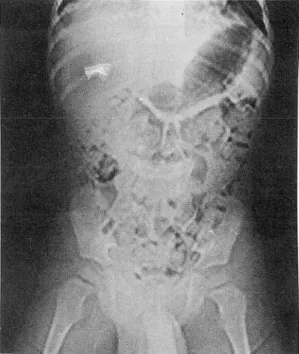 Fig.  1.  Case  1.  CT  scanogram  showing  enlarged  penis  and  scrotal  shadows 