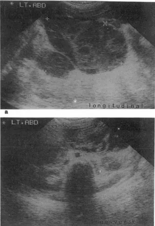 Fig.  6.  a.  b .  Ultrasonography of abdomen.  Multisep. 