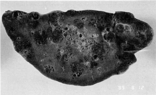 Fig.  l.  CT  feature.  An  enlarged spleen with multiple  small  irregular  low-density  cyst-like  lesions  in  the  entire  spleen