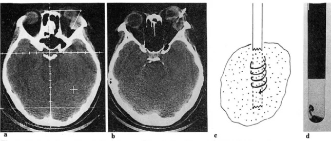 Fig.  1.  The  technique  of  CT  guided  tine  needle  aspiration  biopsy  of  intraorbital  masses
