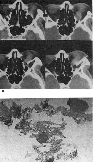 Fig.  5.  Superior  rectus  myositis(pseudotumor) .  a.  (top)  Ax ial  CT  scans  sho Wi ng  diffuse   enlarge-ment  of left  superior  rectus  muscle .(bottom)  Precise  needle  placement within  the enlarged  rectus  muscle 