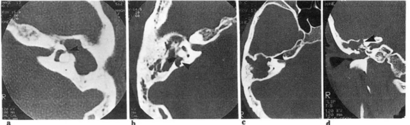 Fig.  1.  Labyrinthlne fistu1a  at lateral semicircular canal(a).  lateral  and  posterior semiclrcular canals(b)  and 