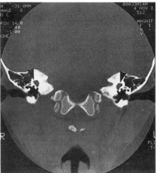 Fig.  3.  Labyrinthine  involvement  is  noted In  trans- trans-verse(a l,  mixed(b l,  and  longitudinal  temporal  bone  fracture(c)