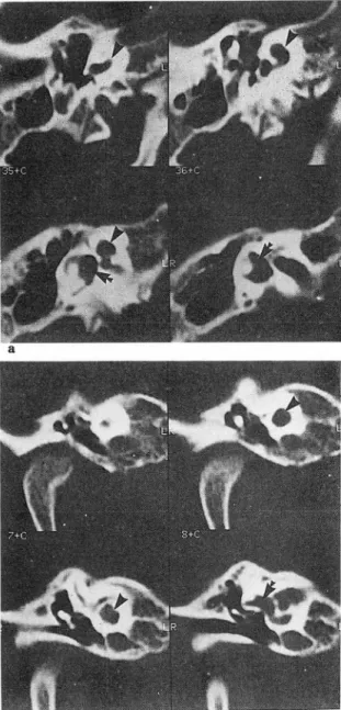 Fig.  5.  Mondini  anomaly(a:  axial.  b:  coronal) :  De- De-creased cochlear turn and single cavity of  apic외  and  middle  turn  of  cochlea(arrow  heads)