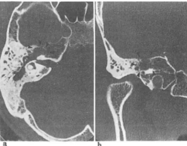 Fig.  7.  Faci aJ  nerve  neuroma of geniculate  ganglion  with  bony  erosion (a:  axi aJ 