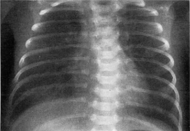 Fig.  1.  Chest PA( 1st day).  The nasogastric tube was  coiled  ln  the  dilated.  air-filled  esophagus   mimick-lng  esophageal  atresia  추적검사상 식도 뒷쪽의  구조물은 점차  작아졌으며 3개월후에는 완전히 소설되어 정상 식도조 영 소견을 보였고(Fig.4) 이후  환아는 경구영양으로 성장하고 있다