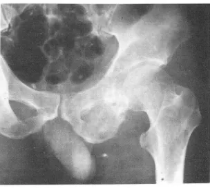 Table  1.  Summary  of  Clinical  and  Radiological  Findings  of  5  alveolar  soft-part sarcoma