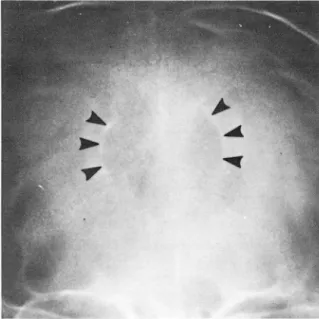 Fig.  1.  Plain  skull  J'I>'l!r  film  shows  a  midline  central  radiolucent  area  with  shell  like  calcification  in  the  periphery(arrowheads)