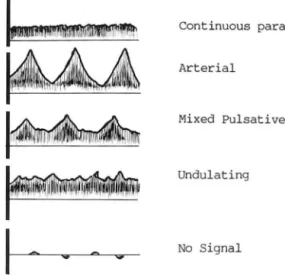 Fig.  L  Fïve  Pattern  of Doppler  Wave  Form  in  port경  류 방향과  정 상 문 맥의 피 형 인  Cont inuous  P.arabo li c  vein 