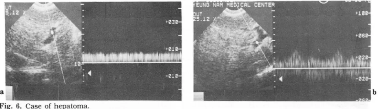 Fig.  6.  Case  of hepatoma. 