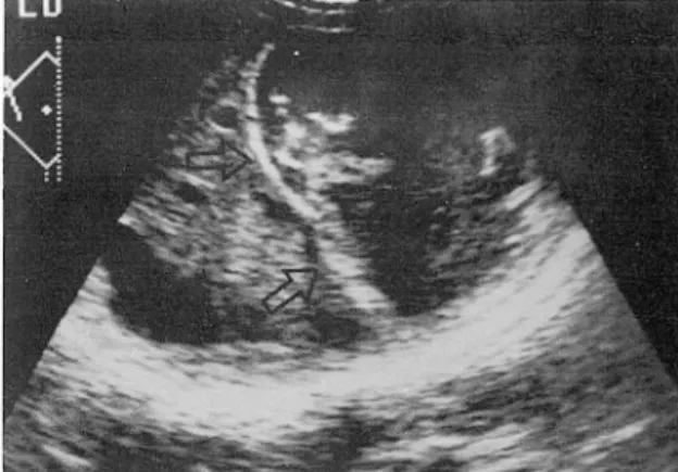 Fig .  1.  Plain  abdomen  ob tained  at  pos tnat al  3 0  minutes(A)  and  2  hours (B )