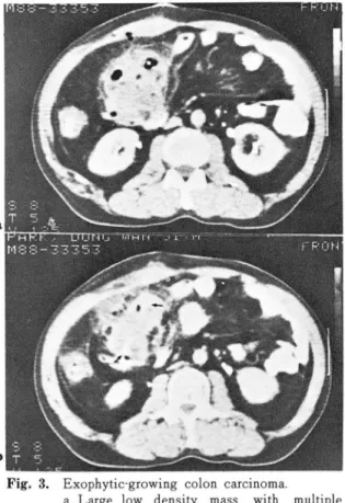 Table  1.  CT  Res ults  in  Detec tion  of  Mass 