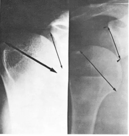 Fig .  1.  Measurement  01  g lenoid  and  Humeral  head  le ngth;  Norma l  shoulder (L t