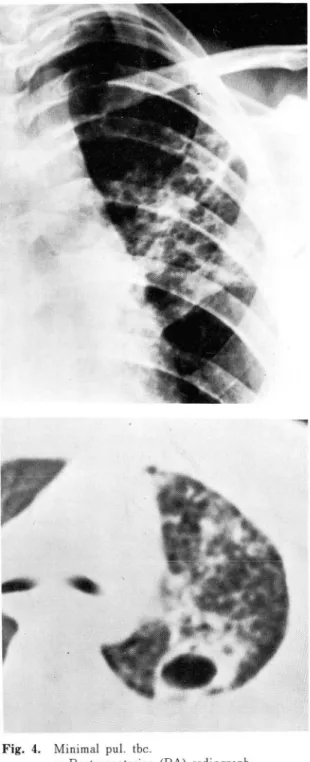 Fig.  4.  Minimal  pu l.  tbc 