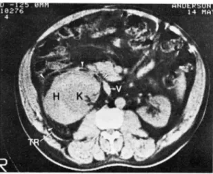 Fig.  3.  Spontaneous  perirenal  hernorrhage  in  a patient  with  hypernephrorna.  Non-enh anced  scan