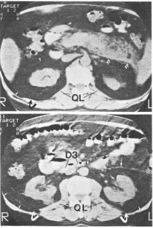 Fig.  5.  Phlegmonous  pancrea titis  showing med ial  ext. 