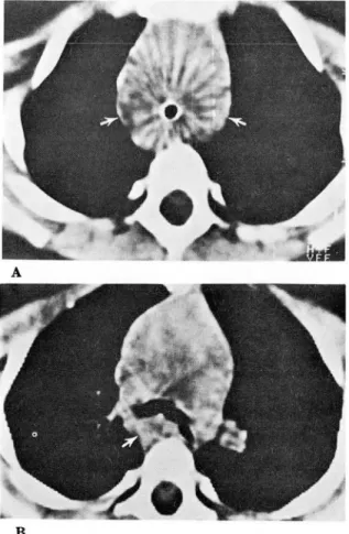 Fig.  3.  Barium  esophagogram  shows  severe  posterior  compression  of  esophagus  at  T4  level 