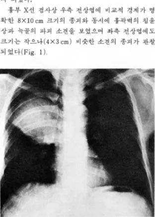 Fig.  2.  Chest  CT  scan:  A  ill  defined  heterogeneous  soft  tissue  m ass  with  anteri o r  chest  wall  invasion  and  rib  destruction 