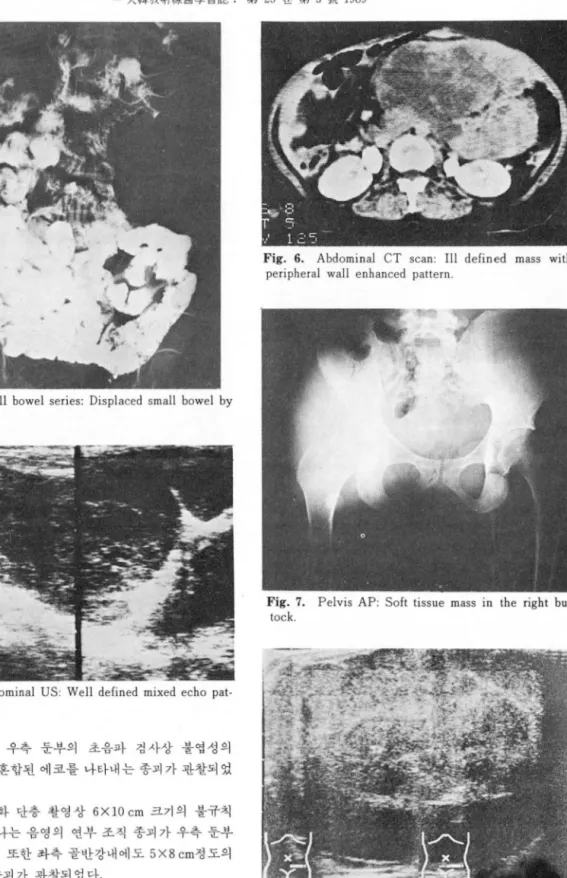 Fig.  4.  Small  bowel  seri es:  Displaced  small  bowel  by  mass 