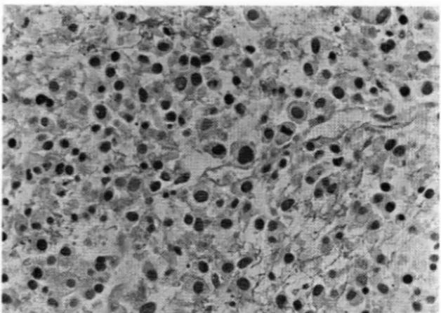 Fig.  10.  Micro:  Hapazardly  arranged  pleomorphic  round  to  oval  shaped  tumor  cell  and  moderate  amount  of  acidophilic  cytoplasm  in  the  background  of  severe  necrosls  주로상염색체  우성으로유전되나  일부는새로운돌연  변이 유전자에 의하여 발생되기도  한다3)  진단은  특정적인  피부 영뻔과