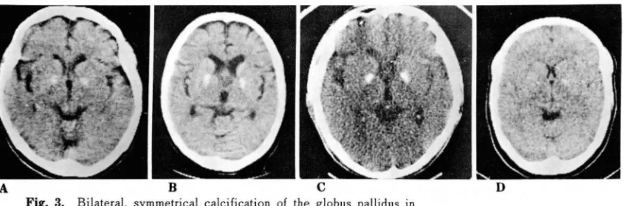 Fig.  3.  Bilateral ,  symmetrical  calcification  of  the  globus  pallidus  in 