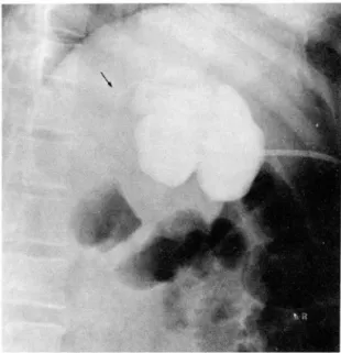 Fig.  4.  Cystogram  demonstrat ing  lob ulated  communi. 