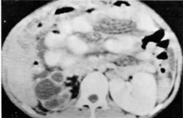 Fig.  2.  Small  contracted  right  kidney  with  diffuse  calyec tasis ,  cortical  thinning  and  lobulated  conto u r