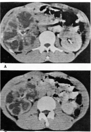 Fig.  5.  Linear  calcifica tions  along  the  marg ins  of  di- di-lated  calyces  of  right  kidney(A)  and  ureter(B ) 